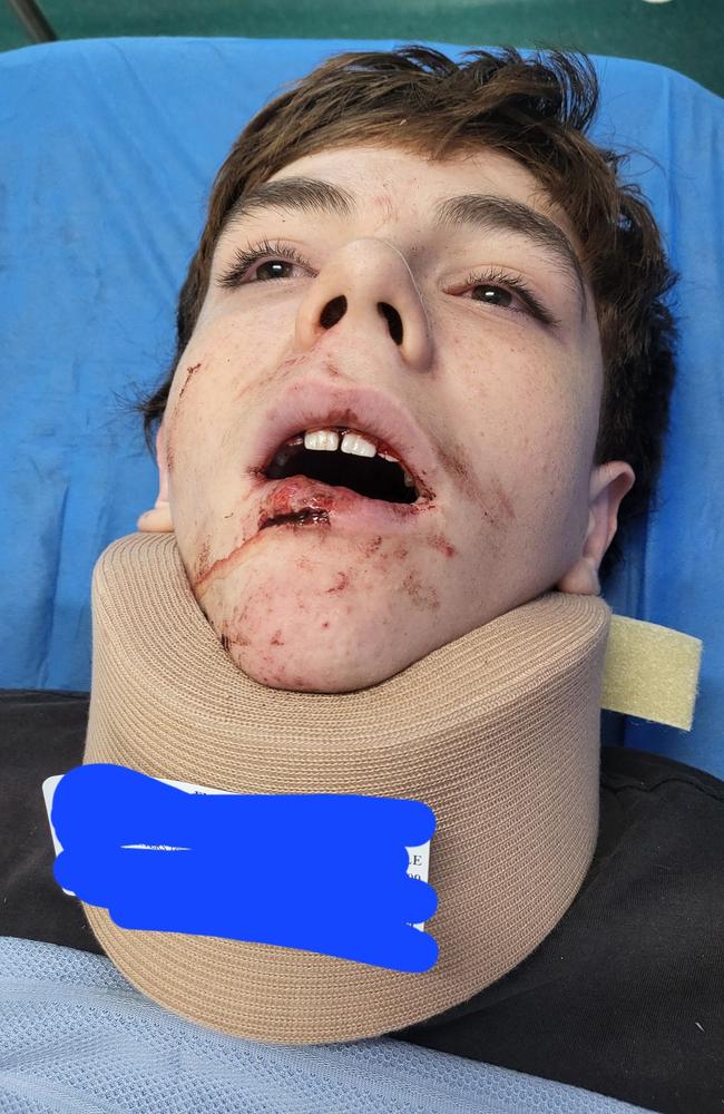 Zavier Harper, a 15-year-old Leukemia survivor sustained facial injuries after crashing his scooter in January 2025. He was flown to Townsville University hospital due to the lack of CT scanner at Charters Towers hospital.