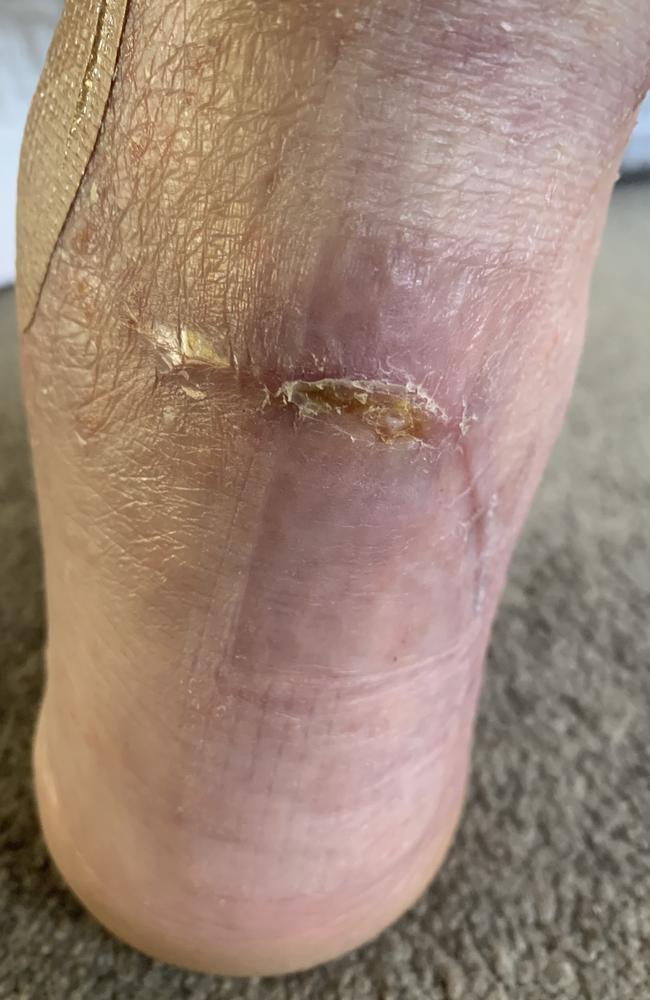 Lance Strong's ulcer has largely healed now. Picture: Supplied