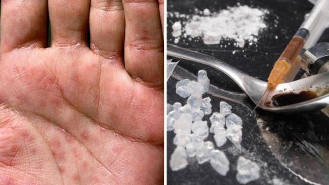 Meth-fuelled orgies are partially to blame for a âhideously scaryâ syphilis spike in northern NSW, according to a public health expert.