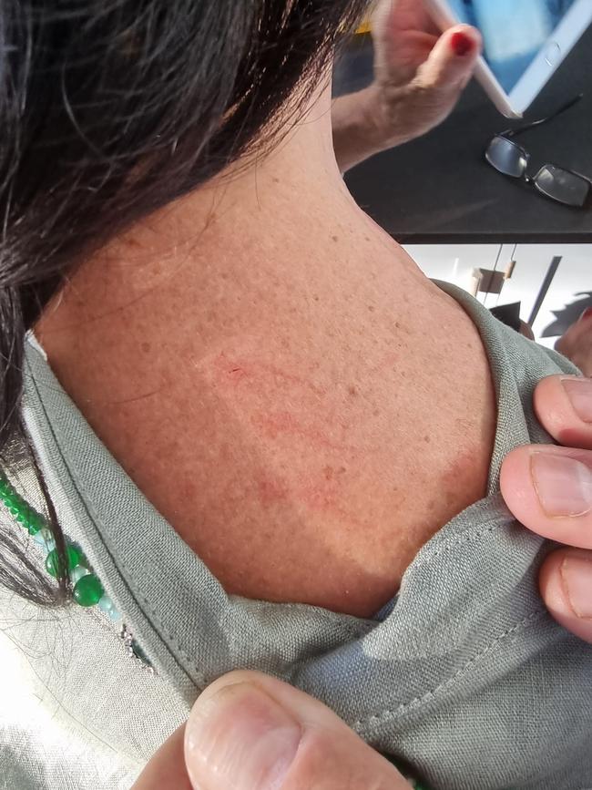 News Corp reporter Natalie O'Brien, showing a scratch on her neck where a bat attacked her on the NSW Central Coast, just days after guests at a wedding had the same encounter with a bat at Hardy's Bistro. Supplied