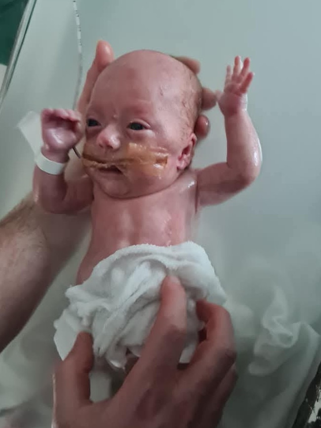 Trial participant Billie Garey was born at 24 weeks. Picture: Supplied