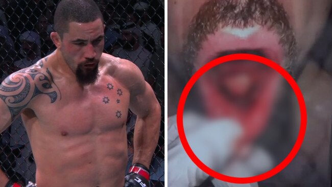 ‘OMG’: Aussie UFC star has jaw shattered