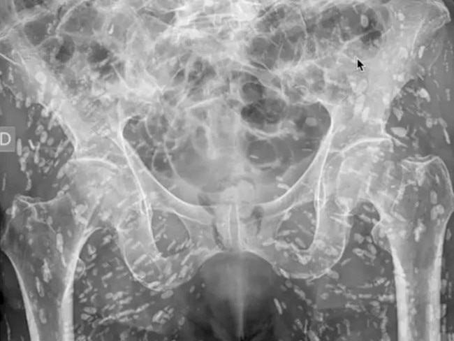 The X-ray revealed the man had hundreds of tapeworm eggs inside him. Picture: X