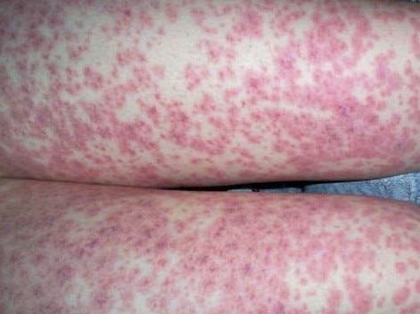 Health authorities issue fresh warnings for meningococcal outbreaks, however stress NOT to wait for a rash before seeking medical treatment.