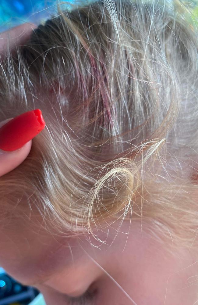 Close up on five-year-old Maci Neeve's injuries after a magpie swooped her at Mulherin Park, Mackay Harbour. Picture: Tianna Neeve