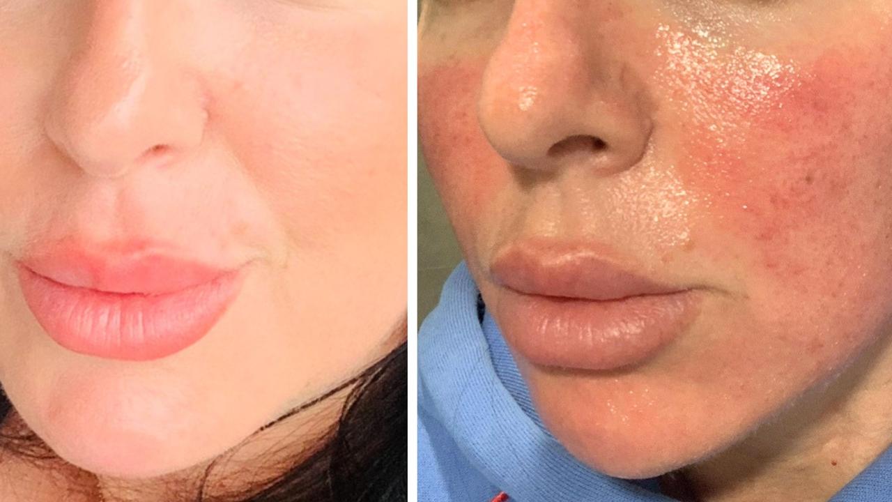 Sarah's skin needling turned into a horrific nightmare as the alarm is sounded over a lack of regulation in Australia. Picture: Supplied