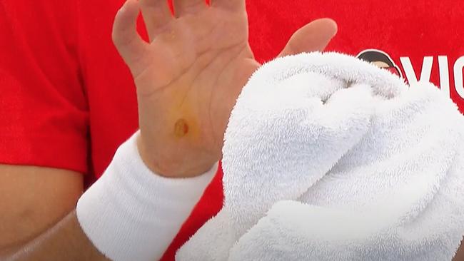 Blisters visible on Novak Djokovic’s hands after he changed his mind and turned up fopr the match.