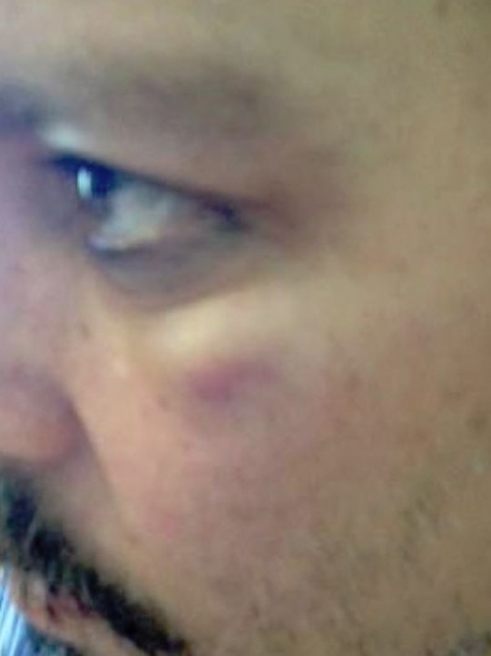 Johnny Depp’s eye appears bruised. Picture: Fairfax County Court