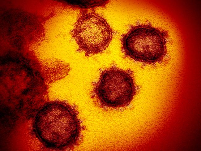 This undated electron microscope image made available by the U.S. National Institutes of Health in February 2020 shows the Novel Coronavirus SARS-CoV-2. Also known as 2019-nCoV, the virus causes COVID-19. The sample was isolated from a patient in the U.S. (NIAID-RML via AP)