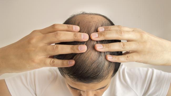 A temporary mass shedding, or increased loss, of hair is common. Picture: iStock.