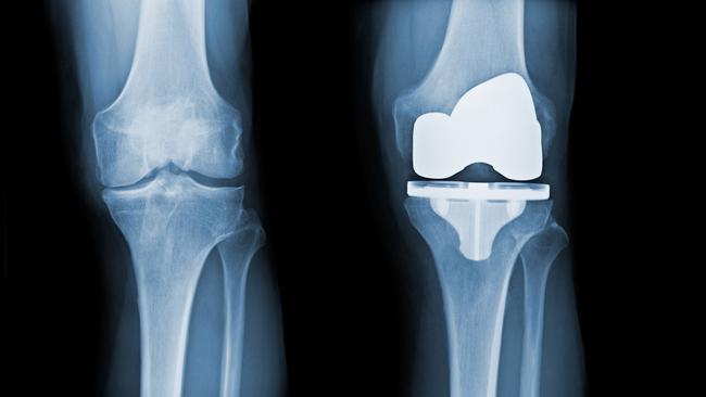 Patients who receive knee replacements in NSW may soon be discharged from hospital the same day. Picture: istock