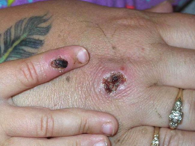 Monkeypox symptoms include legions on the skin. Picture: CDC/Getty Images.