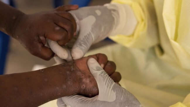 WHO declares mpox outbreak a global health emergency