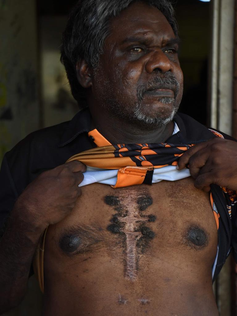 Chadwick Koimala has had multiple heart surgeries since he was diagnosed with rheumatic fever as a child. Picture: (A)manda Parkinson