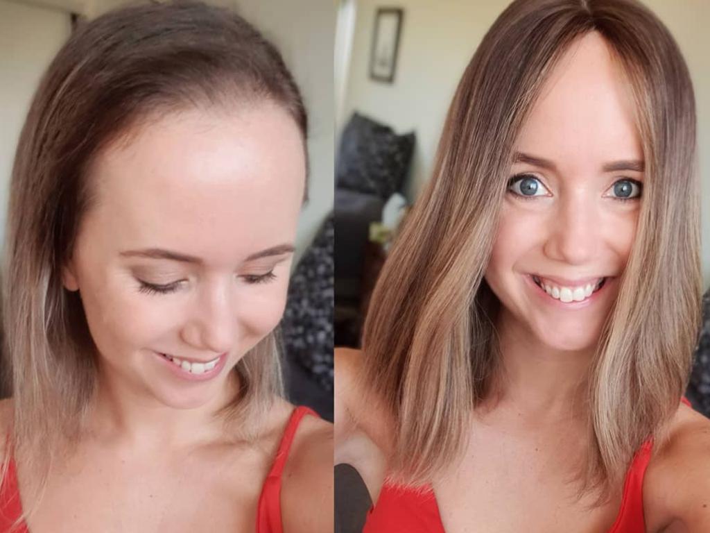 Alopecia Woman Shares Amazing Hair Loss Journey On Instagram The Advertiser