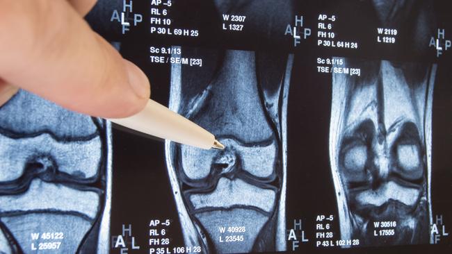 There may soon be a better solution to treatment of osteoarthritis. Picture: iStock