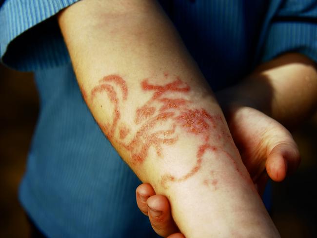 Benjamin Horsington (6) returned from a Bali holiday with his father with a "black henna" tattoo that left scars on his arm along with life-long allergies due to the chemicals used with Black-Henna.