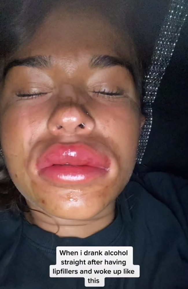 A woman who drank alcohol straight after having lip filler said it was the ‘worst thing’ she could have done, after she got a severe reaction. Picture: TikTok/mp1997x