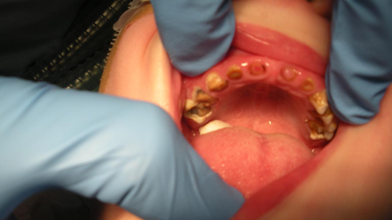 Sugary drinks and food and not enough brushing can lead to severe tooth decay.