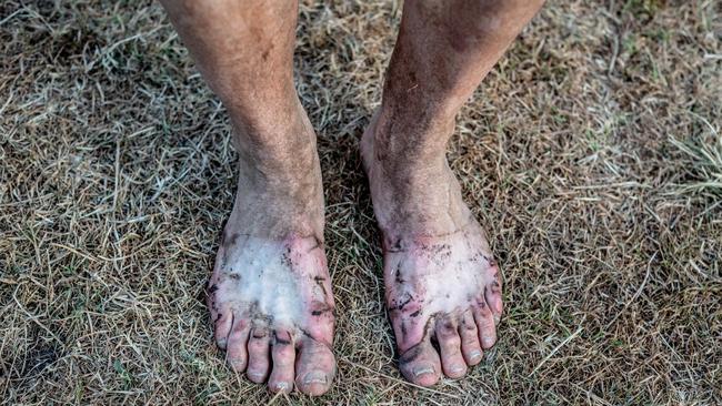 Philip Balnave’s blistered feet after the race. Picture: Marilia Ogayar