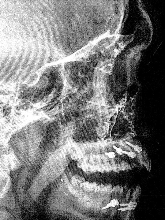 X-Ray of victim's face from the Sporting Globe bashing.