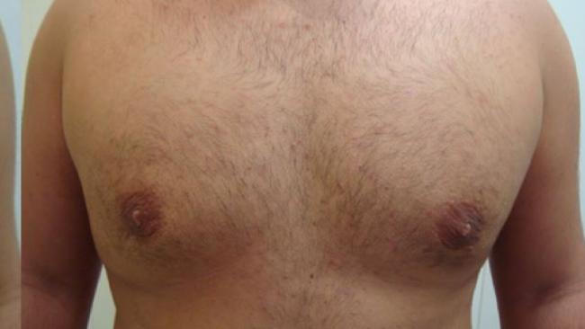 After surgery.