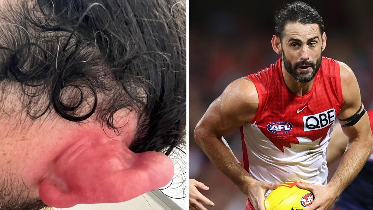 Brodie Grundy's ear heading into the Opening Round win.