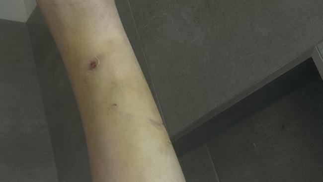 The victim of a vicious dog attack in Ararat doesn’t want the dog to attack anyone else.