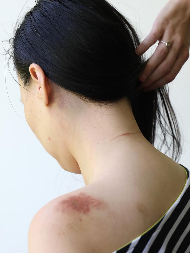 Mengli Jiang showing some of her injuries three days after the fight. Picture: Damian Shaw