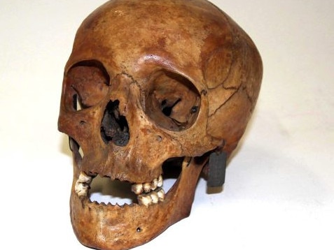 The skull of Lucretia Dunkley. Picture: Supplied