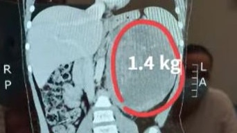 A scan showing the 1.4kg tumour discovered in Charlie's tummy at Townsville hospital on September 14, 2022. Picture: Supplied