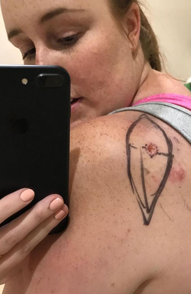 Courtney Mangan, 34, didn’t think anything of her mole until it began to get very itchy and change in colour. Picture: Supplied