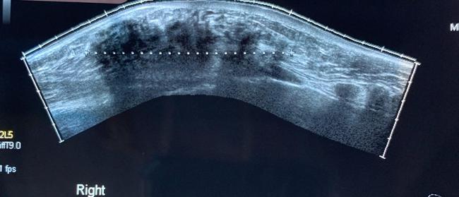 An ultrasound of Narelle’s right breast showing the mass. Image: supplied