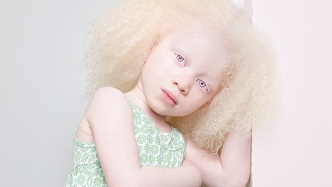 Gorgeous photo series on albinism