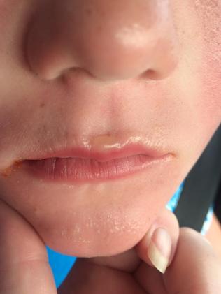 A boy got a blister on his lip. Picture: Facebook