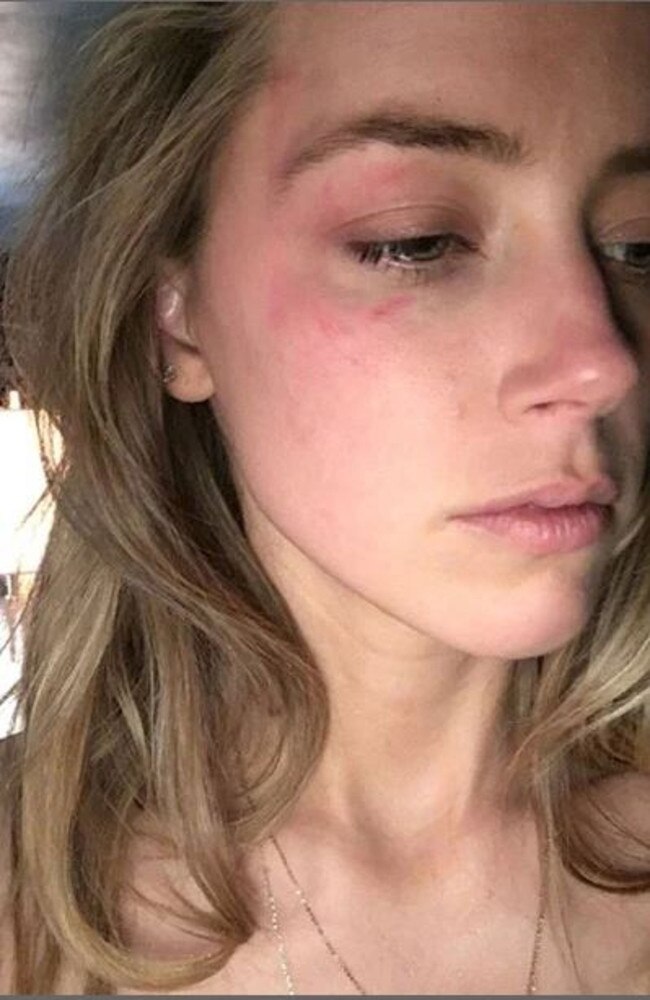 Amber Heard bruised after alleged abuse by Johnny Depp