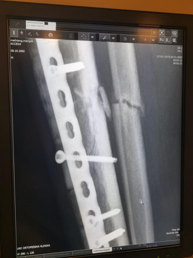 Invasive surgery was required to fix Mangok Mathiang’s leg. Picture: Supplied/Mangok Mathiang