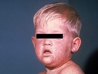 A typical measles rash. Picture: Victoria Department of Health