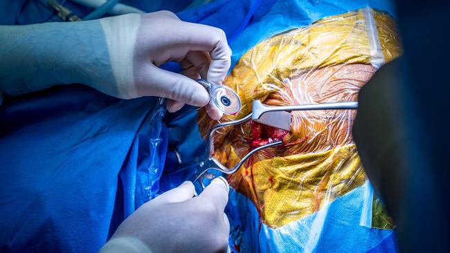 Neurosurgeon Michael Murphy prepares to insert the device. Picture: Jake Nowakowski