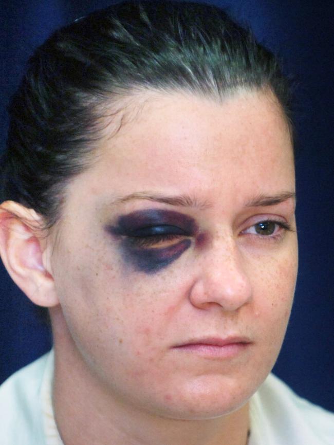 After the coward punch, Tenelle Luscombe sports a shiner – the least of her medical woes.