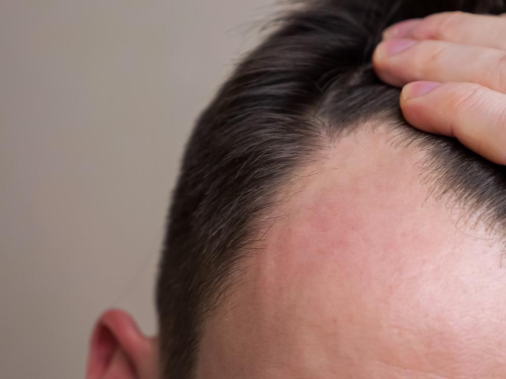 Two common types of hair problems affecting Australian men are either acute shedding or chronic hair loss. Pictured: iStock.