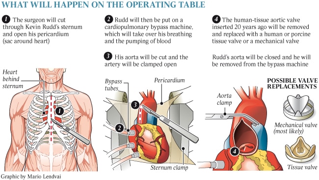 Second heart valve replacement riskier | The Australian