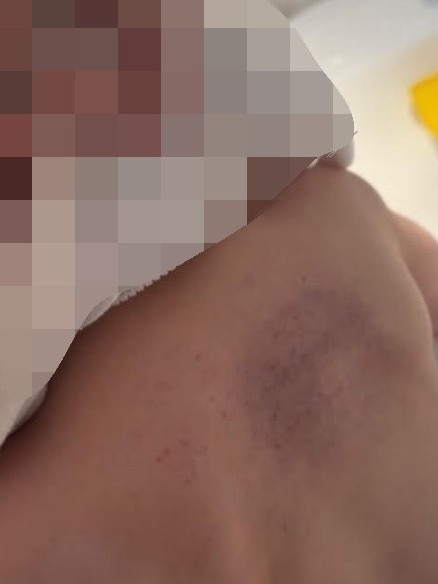 Photos of the bruises allegedly left by childcare worker Angela Evans