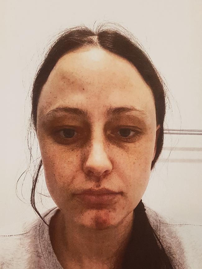 Injuries sustained by SA Police Constable Anthea Beck, inflicted by Raina Jane Cruise. Picture: District Court registry