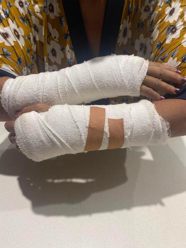 Carole Haddad’s bandaged wrists and hands after the accident.