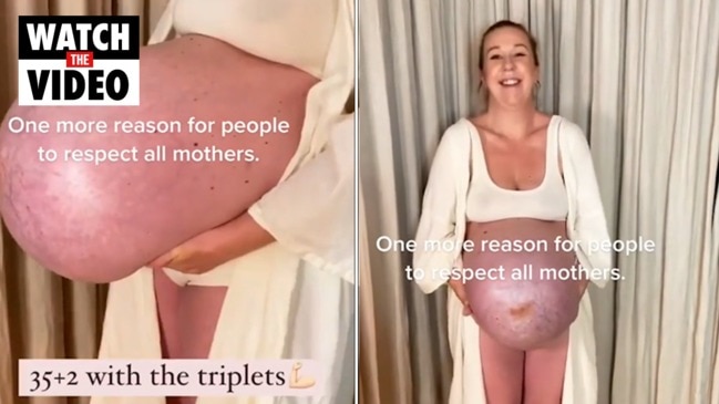 Woman pregnant with triplets documents growth of her INSANELY