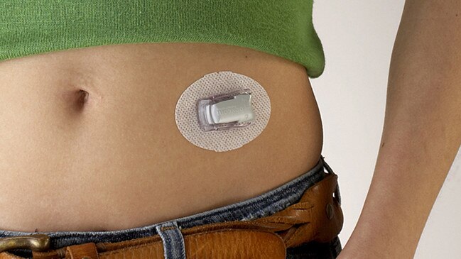 The device will soon be tested in diabetes patients, potentially sparing them the dangerous complications and frequent blood sugar checks and insulin injections. Picture: Juvenile Diabetes Research Foundation