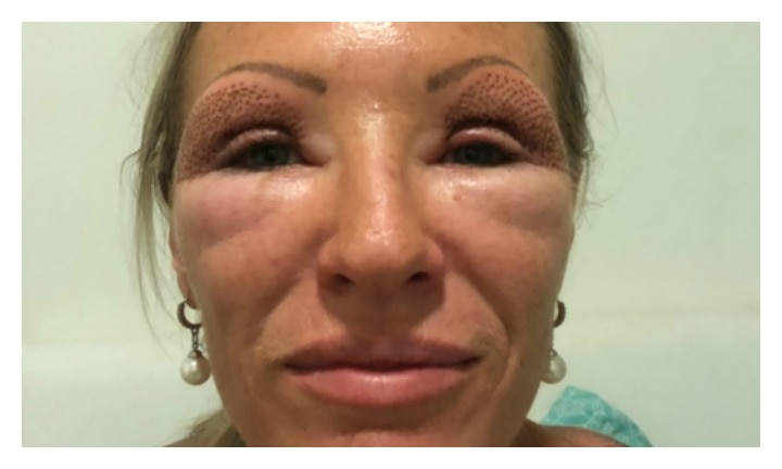 upper blepharoplasty gone wrong