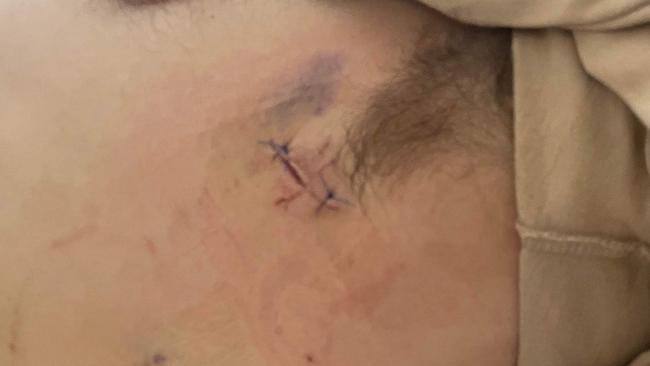 The injuries to Ryan Duck's side after a knife was allegedly plunged through his bicep and into his chest. Picture: Supplied