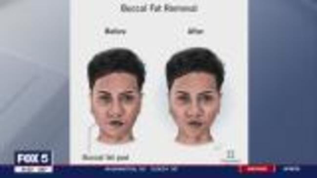 Buccal Fat Removal: Why it’s popular and the risks that come with it